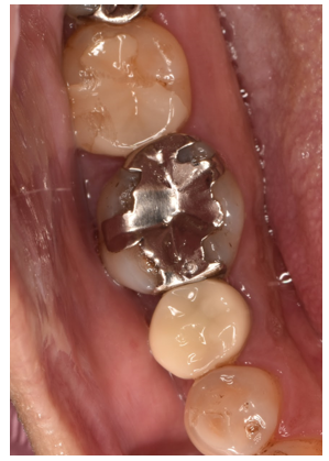 50代男性「銀歯を白くしたい」E-max のインレーで白くした症例