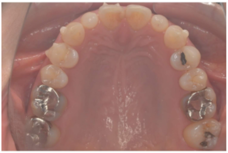 40代女性「歯並びを治したい、銀歯を白くしたい」インビザライン矯正とセラミック治療