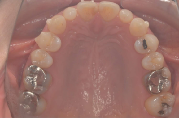 40代女性「歯並びを治したい、銀歯を白くしたい」インビザライン矯正とセラミック治療の症例