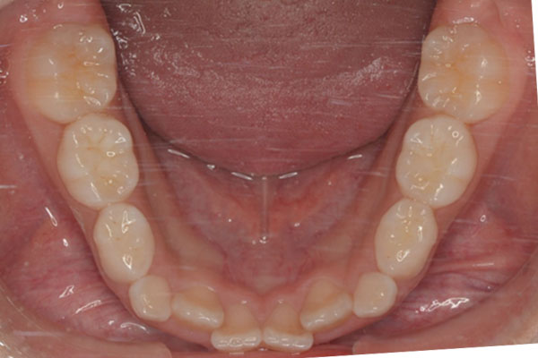 7歳男の子「下の歯がガタガタに生えている」小児矯正で治療した症例