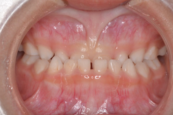 5歳男の子「乳歯の前歯のかみ合わせがおかしい」マイオブレースで小児矯正をした症例