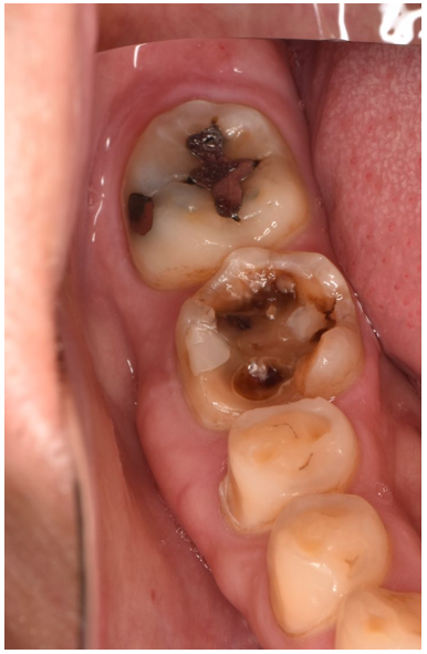 40代男性「詰め物が取れた」ジルコニアのインレーで白く治療した症例