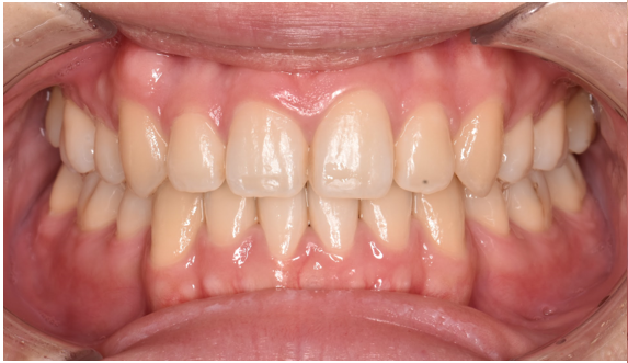 20代女性「歯が黄色い、白くしたい」オフィスホワイトニングで白くした症例