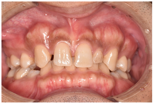 20代男性「前歯の着色が気になる」保険のクリーニングで着色を除去した症例