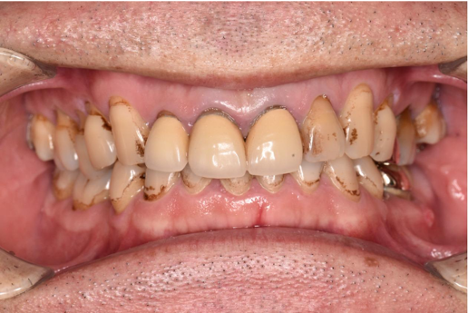 50代男性「歯についた黒ずみが気になる　5年程歯科に行っていないため、しっかりクリーニングを受けたい」縁上歯石・着色を除去し、その後歯周治療を行った症例