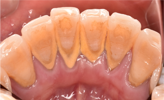 40代女性「クリーニングの音が苦手だけど歯石をとってほしい」 超音波スケーラーと手用スケーラーで縁上歯石を除去した症例