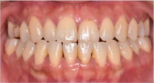 20代女性「歯石を取ってほしい、歯の根元が黒くなっているのが気になる」縁上歯石を除去し、その後歯周治療を行った症例