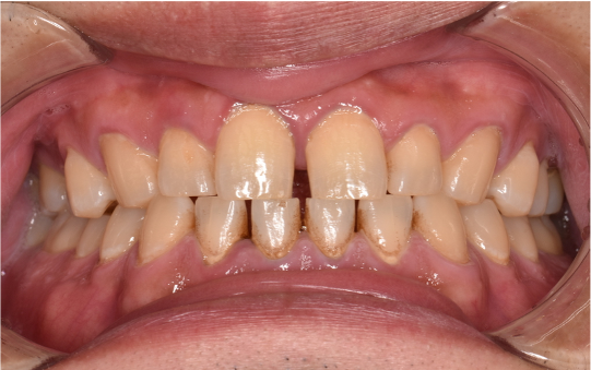 30代男性「タバコのヤニが気になる」縁上歯石・着色を除去し、その後歯周治療を行った症例