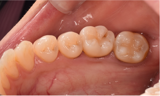 20代女性「歯の裏側を頑張って磨いても黒いのが取れない　むし歯なのか心配なため、診てほしいです」歯周病治療を行った症例