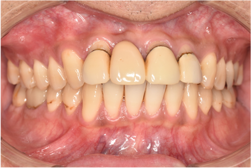 30代男性「前歯の被せ物を白くしたい」とセラミックで白く治療した例