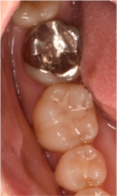 30代女性「銀歯が外れた、目立ちにくく長持ちするものにしたい」E-maxのインレーで白くした症例