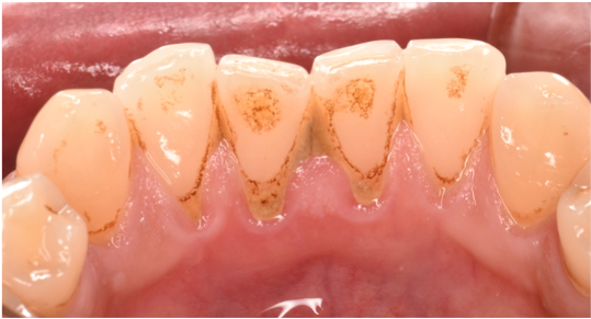 50代男性「検診とクリーニングをしてほしい」縁上歯石を除去した症例