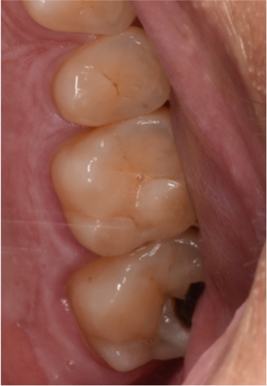 30代男性「左上の奥歯がしみたり鈍痛がする」フルジルコニアクラウンで治療した症例