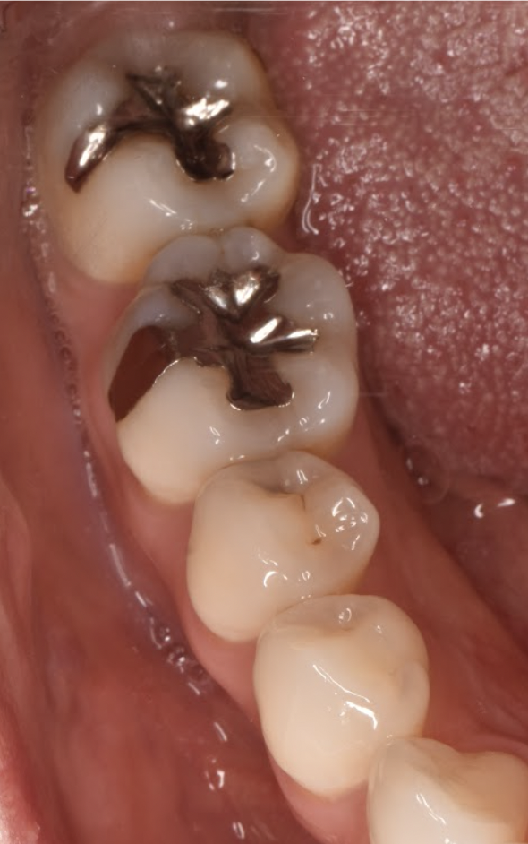 30代女性「金属の被せものを白い被せものに変えたい」E-max Inで白くした症例