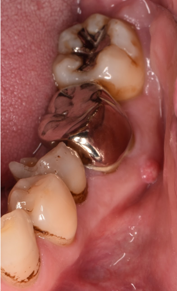 50代男性「左下の被せ物が取れた」根管治療と虫歯治療後にCAD/CAM冠とCR充填を行い、保険の範囲で治療した症例