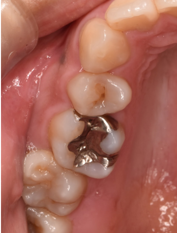 30代女性「右上の金属が入っている部分が痛む」むし歯と神経の治療後にジルコニアクラウンを被せた症例