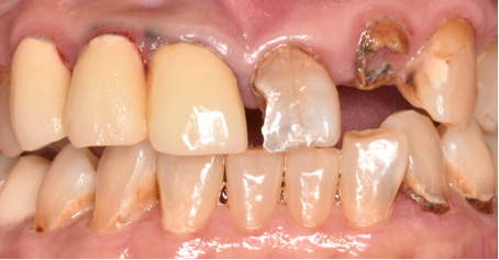 60代女性「前歯の差し歯が取れた」抜歯後に前装冠ブリッジで治療した症例