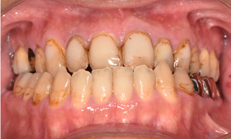 40代男性「前歯の詰め物の色を治したい」変色していた歯頚部の詰め物をCR（保険治療）で白くした症例