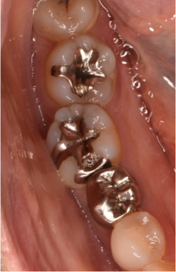 40代女性「銀歯が浮いている気がする」メタルインレーを自費のE-maxインレーと保険のCRでやり替えた症例