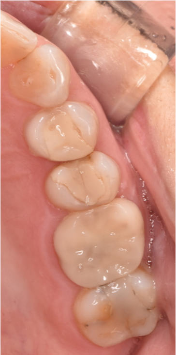 40代女性「歯の隙間に食べ物が挟まる」メタルインレーを自費のE-maxインレーでやり替えた症例