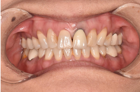 40代女性「前歯の被せ物の色が気になる」オールセラミッククラウンを被せた症例