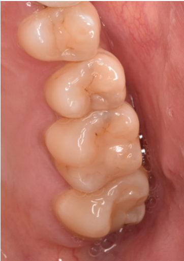 30代女性「歯がしみる」虫歯になっていた左上の奥歯をE-maxインレーで治療した症例
