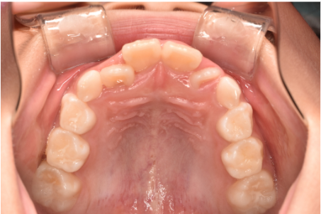 7歳女の子「上の前歯がガタガタ」マイオブレースとバイオブロックを使用した患者の治療経過