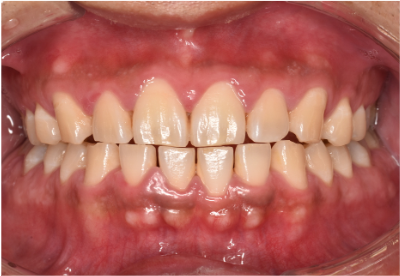 30代男性「歯が痛い」虫歯治療後に歯石やプラークの除去とブラッシング指導で歯周炎を改善した症例