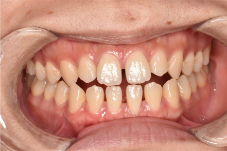 20代女性「歯の隙間を矯正で治したい」インビザライン矯正で治療した症例