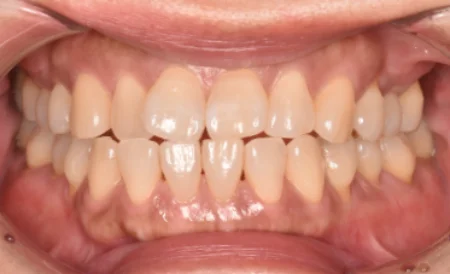 40代女性「歯を白くしたい」強い黄ばみをオフィスホワイトニングで全体的に白く改善した症例