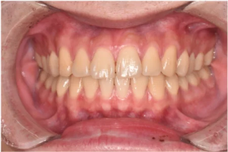 20代男性「歯を白くしたい」全体的な黄ばみをなるべくしみないオフィスホワイトニングで白く審美的に回復した症例