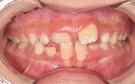 7歳男の子「上の前歯1本が内側に生えている」マイオブレースを使用した噛み方や舌の癖を治すトレーニングと拡大装置（バイオブロック）を使って小児矯正をした症例