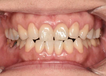 50代女性「歯を今よりも白くしたい」オフィスホワイトニングで歯を全体的に白くした症例