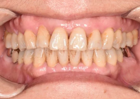 50代女性「短期間で歯を白くして、長持ちさせたい」黄ばみや着色で見た目が悪くなっていた歯全体をオフィスホワイトニングで白くした症例