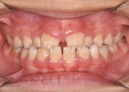 8歳男の子「噛み合わせが反対になっている」保険診療にて口腔機能トレーニングを行った症例