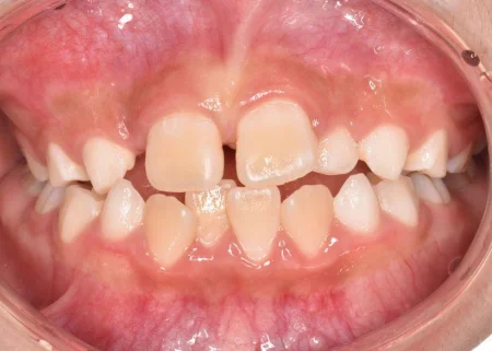 7歳男の子「歯並びが気になる」ガタガタに生えている歯をマイオブレースによる小児矯正で改善した症例