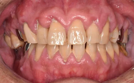 50代男性「歯石を取ってほしい」歯茎の変色や出血を伴っていた重度の歯周病を歯の表面のクリーニングと歯周治療で改善した症例