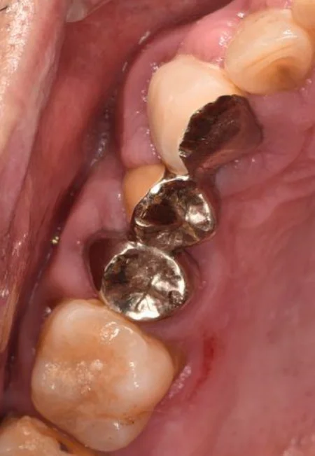 50代男性「右上のブリッジを白くて強度が高いものに変えたい」保険のブリッジを除去し、自費のオールセラミックとフルジルコニアで作り直した症例