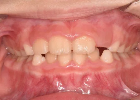 7歳女の子「歯並びの悪さ、特に下の歯のガタガタが気になる」マイオブレースを用いた筋機能訓練を中心に、インビザライン矯正治療も併用した症例