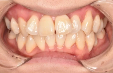 30代女性「上の歯並びを綺麗にしたい」セラミックの被せ物により、ガタガタに生えていた前歯の見た目を短期間で改善した症例