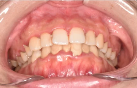 20代女性「歯科検診をしてほしい」約10年ぶりの歯医者で、付着していた歯石の除去とブラッシング指導により歯周病治療を行った症例