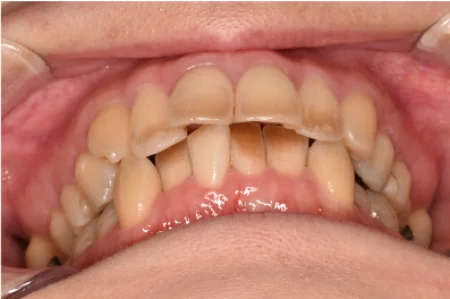 30代女性「歯のメインテナンスをしたい」ブラッシングとエアフローで歯の表面の着色汚れをきれいに取り除いた症例