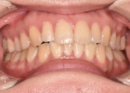 20代女性「歯の黄ばみや着色が気になる。歯を白くしたい」全体的に暗いトーンだった見た目をオフィスホワイトニングで白く改善させた症例