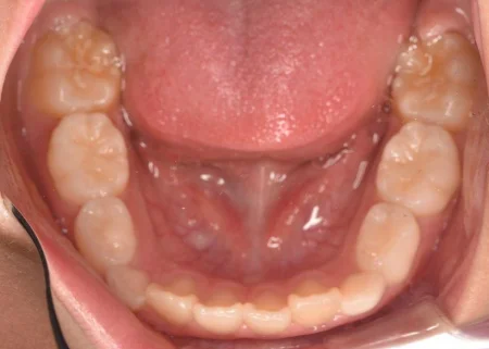 8歳男の子「下の歯並びがガタガタしているので治したい」歯が生えるスペースが不足して前歯が前後していた部分をマイオブレースを使用したトレーニングで治療した症例