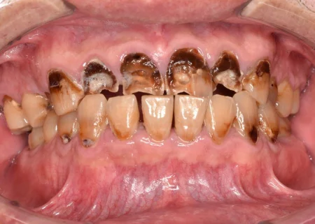 50代男性「虫歯を治したい」歯科恐怖症で放置していた虫歯を取りきり被せ物で修復し、歯周病も併せて治療した症例