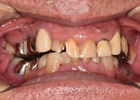 70代男性「前歯が折れた」仮歯を装着しながら神経の治療から被せ物の作製まで行った症例