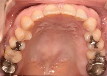 40代女性「銀歯を白くしたい」奥歯の複数の詰め物と被せ物を全てセラミックとジルコニアで白く作り直した症例