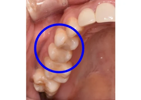 30代女性「歯がしみる」2次的な虫歯を取り除き、自然な見た目で強度もあるセラミック「E-maxインレー」で治療した症例