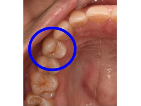 30代女性「右上の歯がしみる」虫歯になった歯を、透明感のある白さで強度もあるセラミックの「E-maxインレー」で見た目も美しく修復した症例