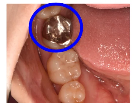50代女性「右下奥歯の銀歯が外れた。見た目が良くて外れにくい自費の詰め物に変えてほしい」詰め物が合わず虫歯になった歯を、透明感のある白さでフィット感が良い「e-max」で修復した症例
